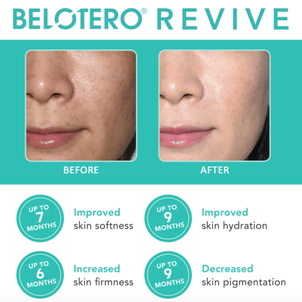 belotero-revive-everderm