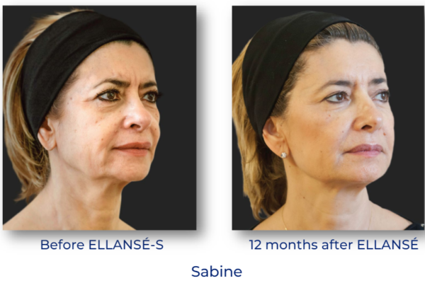 Ellanse before-after 1