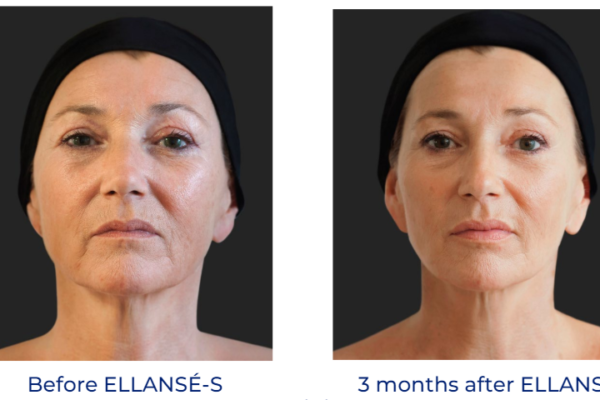 Ellanse before-after 4