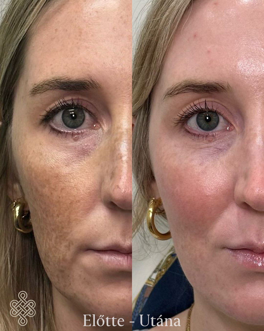 pigment-before-after